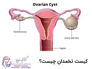 کیست تخمدان چیست؟