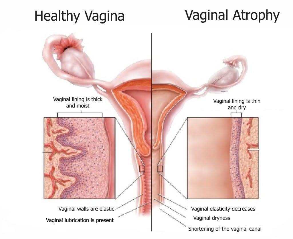 خشکی واژن