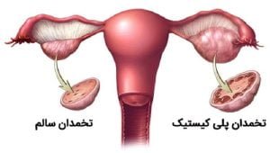 تخمدان پلی کیستیک