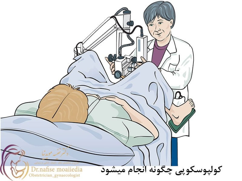 کولپوسکوپی چگونه انجام میشود