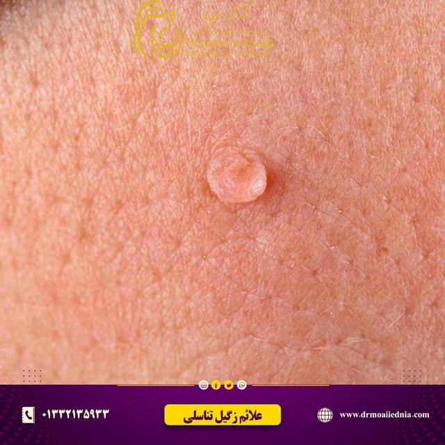 عکس-زگیل-تناسلی