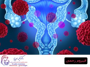 فیبروم رحمی