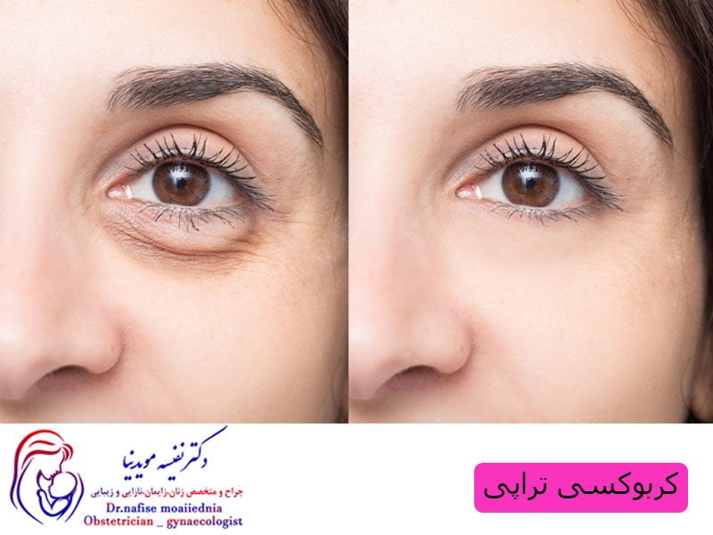 کربوکسی تراپی