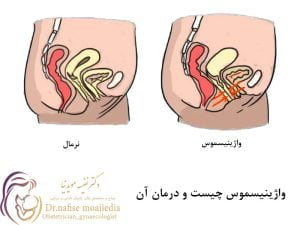 واژینیسموس چیست