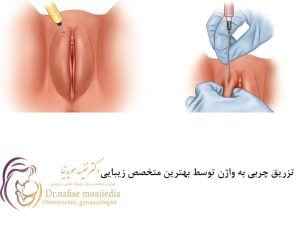 تزریق چربی به واژن
