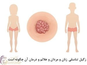 زگیل تناسلی
