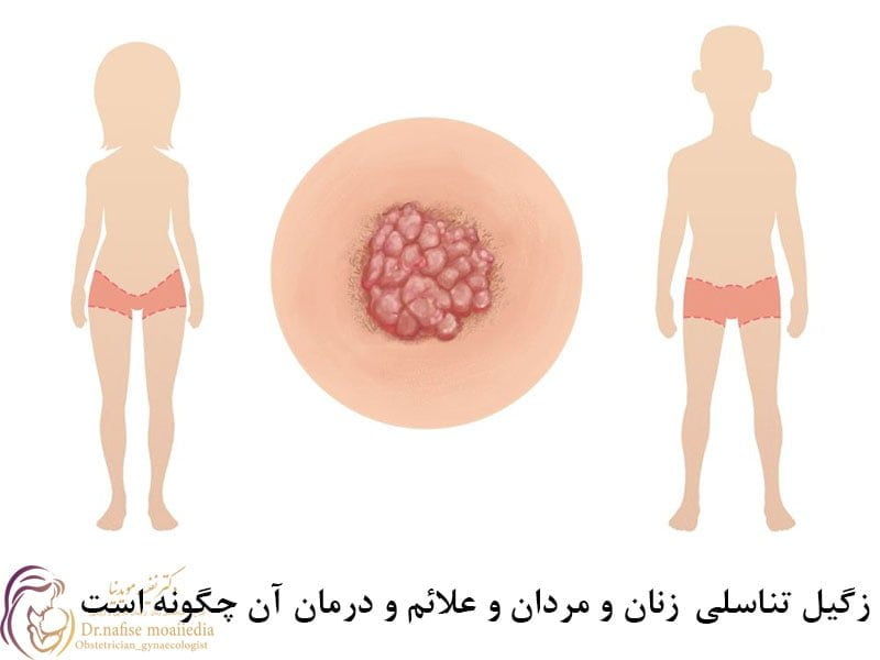 زگیل تناسلی