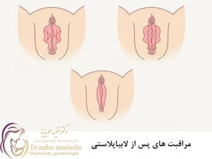 مراقبت های پس از لابیاپلاستی