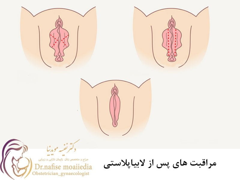 مراقبت های پس از لابیاپلاستی