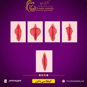 لابیاپلاستی-با-لیزر