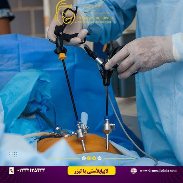 لاپاراسکوپی-کیست-تخمدان