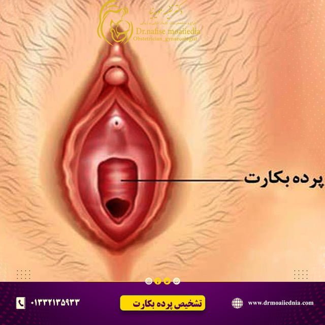 تشخیص-سلامت-پرده-بکارت
