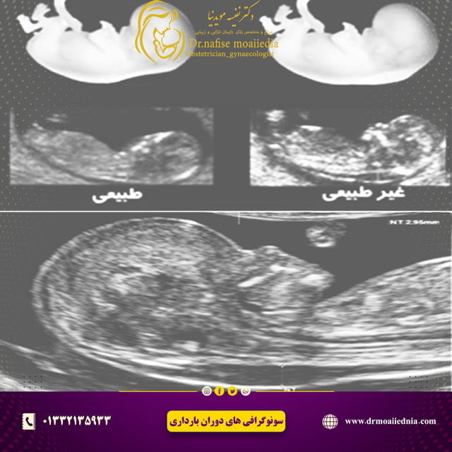 سونوگرافی-nt