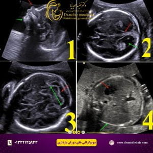 سونوگرافی-آنومالی