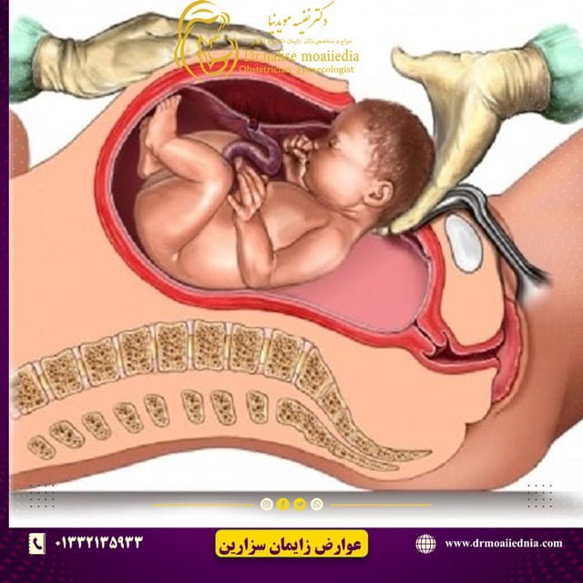 عوارض-زایمان-سزارین