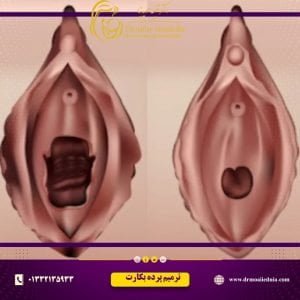 ترمیم-پرد-بکارت
