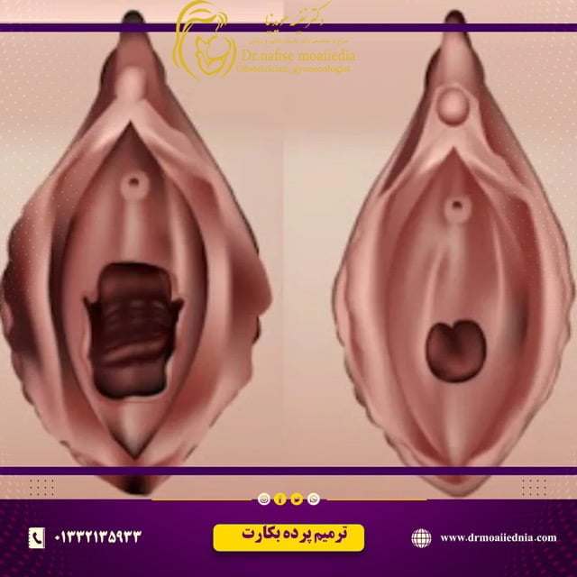 ترمیم-پرد-بکارت