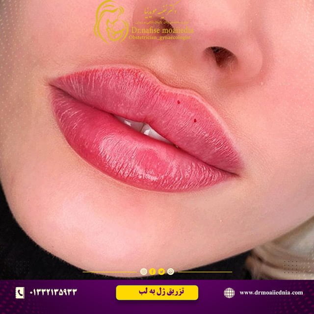 تزریق-ژل لب