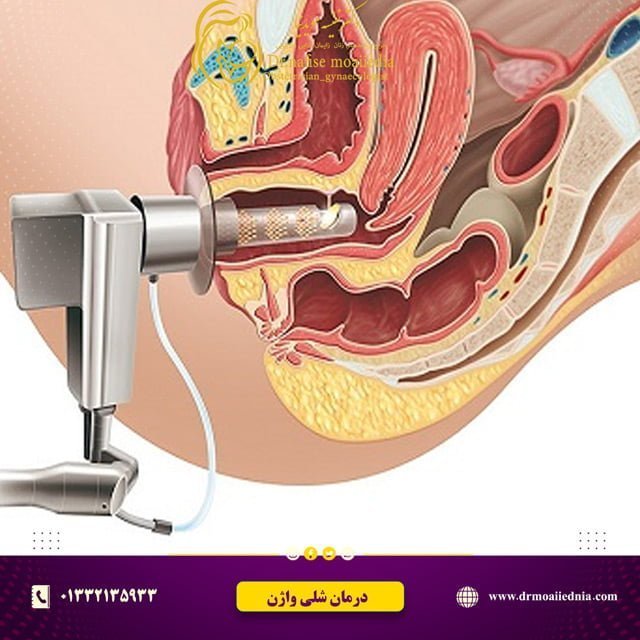 درمان-شلی-واژن-با-لیزر