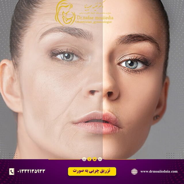 تزریق چربی به صورت
