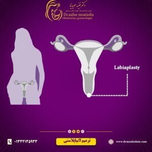 عمل ترمیم-لابیاپلاستی