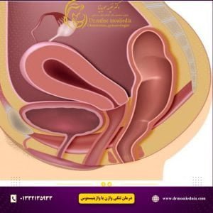 درمان-تنگی-واژن-و-مشکل-دخول-یا-بیماری-واژینیسموس