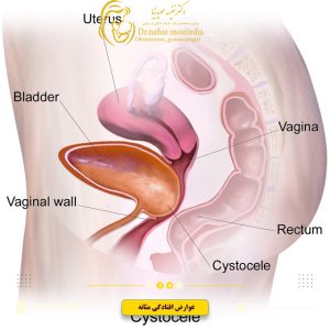 عوارض-افتادگی-مثانه