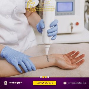 از-بین-بردن-تاتو-با-لیزر