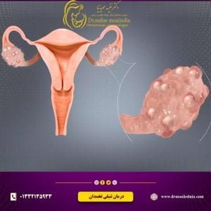 درمان-قطعی-تنبلی-تخمدان