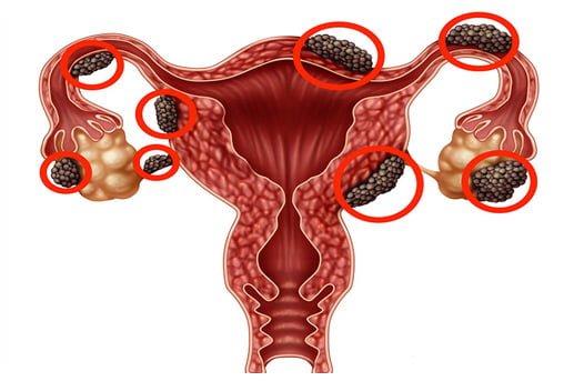 عکس اندومتریوز
