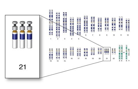 کروموزوم-های-سندروم-داون